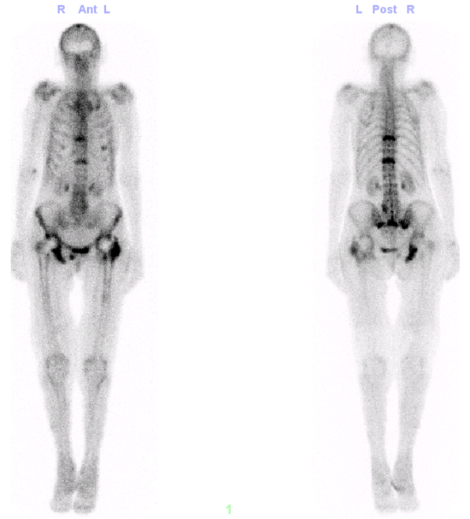 Obr. č. 2: Celotělové zobrazení v kostní fázi vyšeřtení v AP a PA projekci – patrná plošná ložiska výrazně zvýšené kumulace v oblasti TH8, Th11, ve střední časti křížové kosti a dolních částech obou SI kloubů, pravé sedací kosti, 5. žebru levého hemithoraxu – kde je jen částečně zvýšená kumulace.