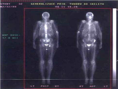 TechneScan HDP: scintigrafie skeletu