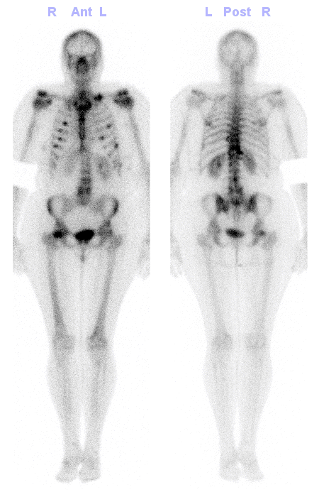 Obr. č. 2: Celotělová scintigrafie skeletu v kostní fázi vyšetření – mnohočetná ložiska zvýšené kostní přestavby ve výše uvedených lokalizacích.