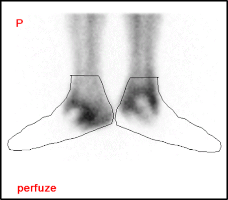 Obr. 3: Projekce nohou v perfúzní fázi s orientačně vyznačeným obrysem. Perfúze tkání prstů, nártů a proximálních částí tarzů chybí.