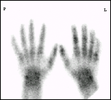 Obr. 6: Projekce rukou, skelet se zobrazuje kompletně, postižení odpovídá I. – II. stupni.