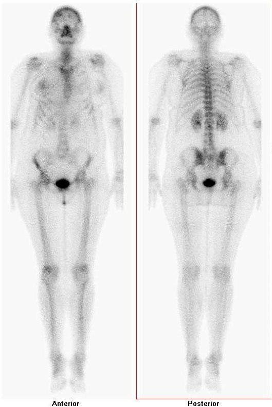 Obr. č. 1: Celotělová scintigrafie skeletu v přední a zadní projekci s nálezem zvýšené akumulace radiofarmaka v kalvě frontálně oboustranně, nevýrazně v čéškách, vedlejším nálezem byla asymetrická akumulace v prsní tkáni.