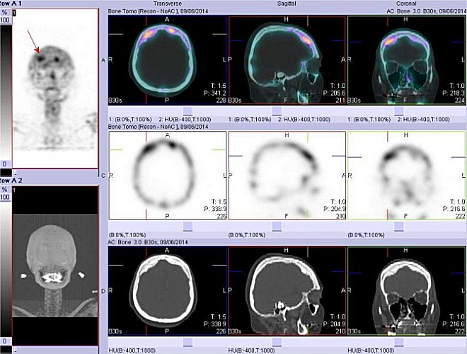 Obr. č. 3: SPECT/low dose CT lebky s nálezem zvýšené akumulace radiofarmaka v kalvě frontálně oboustranně. V CT obraze je patrné lehce asymetrické ztluštění vnitřní laminy frontální kosti. Horní řada 3 obrázků jsou tomografické fúzované snímky, prostřední řada jsou scintigrafické tomografické snímky, dolní řada jsou CT snímky.