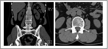 Obr. . 3: CT trupu  vlevo koronrn rovina, vpravo rovina transverzln. V oblasti L3 dorsolaterln vlevo je hypodenzn loisko s jemnm sklerotickm lemem, kter m centrln votinovit vzhled s vertikln zdraznnou trabekulizac, Lze m velikost 19x22x22 mm a odpovd hemangiomu.