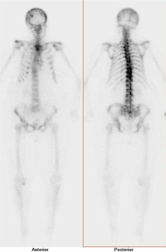 Obr. č. 1: Celotělová scintigrafie skeletu v přední a zadní projekci s nálezem difúzně zvýšené a nehomogenní akumulace radiofarmaka v oblasti axiálního skeletu - převážně v hrudní páteři a žebrech, v hrudní kosti, v kalvě frontoparietálně vpravo. Apendikulární skelet je zobrazen chabě, nejsou zobrazeny ledviny. Nález odpovídá mnohočetné diseminaci maligního onemocnění do skeletu - jedná se o tzv. „suprescan“.
