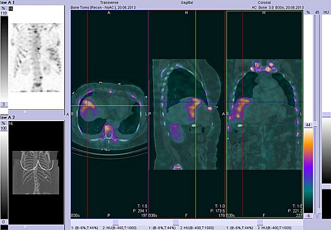 Obr.č.3: Fúze obrazů SPECT/CT.  Zaměřeno na patologické  ložisko v pravém jaterním laloku. Řez transverzální, sagitální a  koronální.