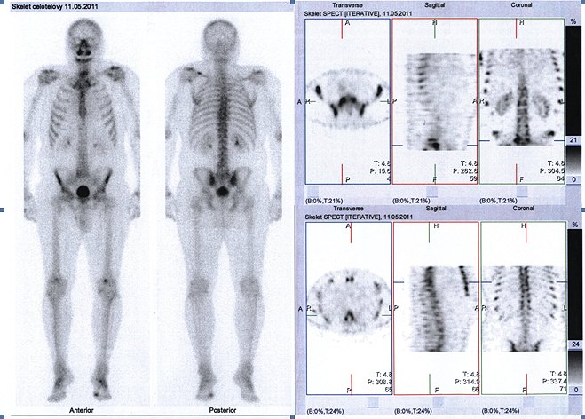 Obr..1: : Celotlov scintigrafie skeletu v pedn a zadn projekci doplnn o tomografickou scintigrafii (SPECT) bedern a doln hrudn ptee.