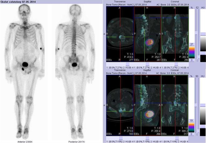 Obr.č.1: Celotělová scintigrafie v přední a zadní projekci a fúze obrazů SPECT a CT.  Vpravo zaměřeno na ložiska v bederní páteři. Řezy transverzální, řezy sagitální a řezy koronární.