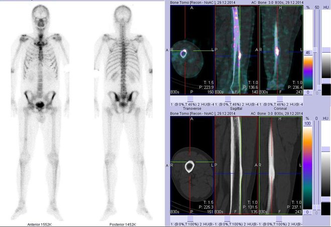 Obr. č. 4: Celotělová scintigrafie v přední a zadní projekci a fúze obrazů SPECT a CT. Vpravo zaměřeno na ložisko ve ventrální části pravé kosti stehenní – vpravo nahoře fúze obrazů SPECT a CT, vpravo dole CT. Vpravo řezy transverzální, řezy sagitální a řezy koronální.