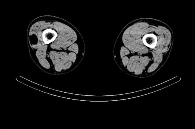 Obr. č. 5: „low dose“ CT obou stehen – transverzální řez.