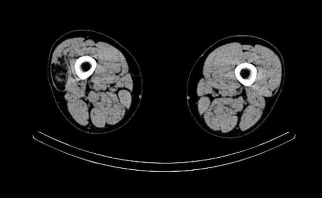 Obr. č. 6: „low dose“ CT obou stehen – transverzální řez.