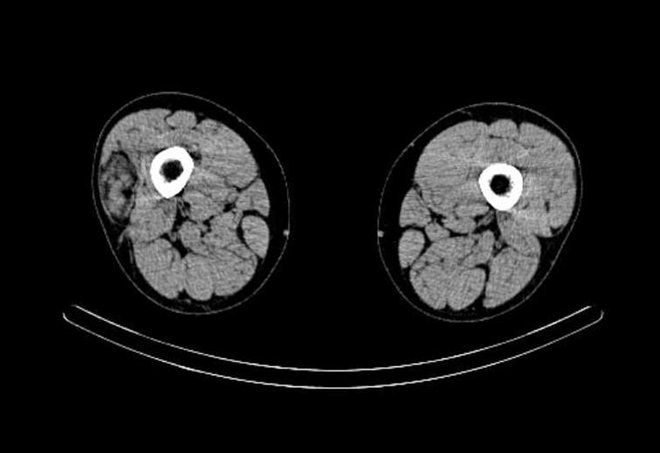 Obr. č. 7: „low dose“ CT obou stehen – transverzální řez.