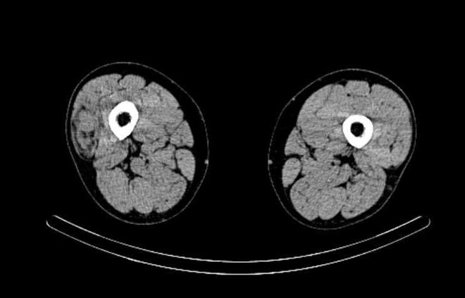 Obr. č. 8: „low dose“ CT obou stehen – transverzální řez.