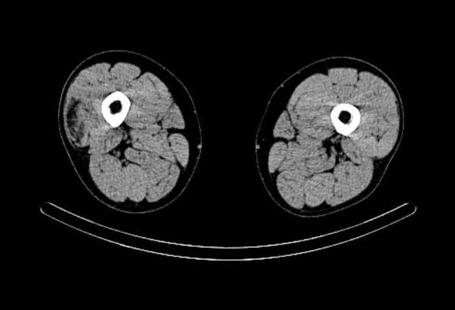 Obr. č. 9: „low dose“ CT obou stehen – transverzální řez.