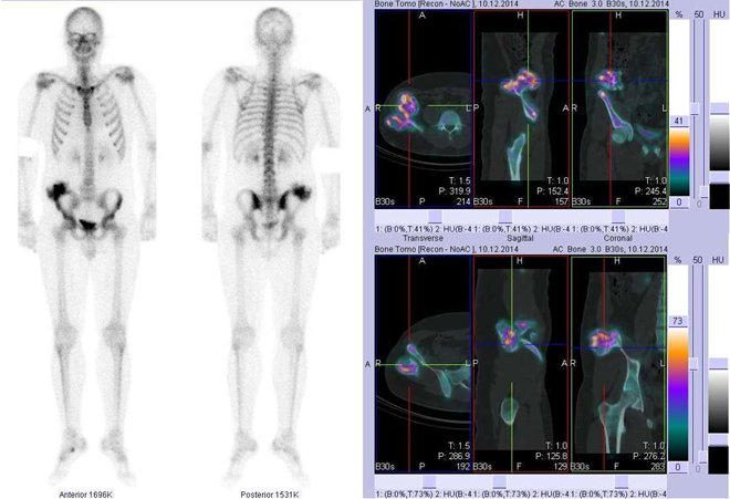 Obr.1: Celotělová scintigrafie v přední a zadní projekci a fúze obrazů SPECT a CT. Vpravo fúze obrazů SPECT a CT - zaměřeno na ložisko v laterokraniální části lopaty pravé kosti kyčelní. Vpravo řezy transverzální, řezy sagitální a řezy koronální.