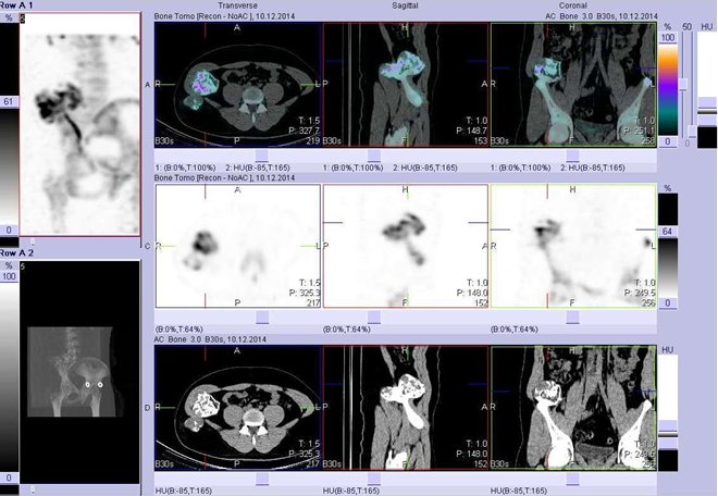 Obr.č.2: Fúze obrazů SPECT a CT. Zaměřeno na velké ložisko v laterokraniální části lopaty pravé kosti kyčelní. Řezy transverzální, řezy sagitální a řezy koronální.