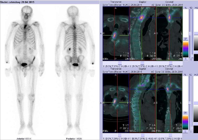 Obr.č.3: Celotělová scintigrafie v přední a zadní projekci a fúze obrazů SPECT a CT.  Vpravo zaměřeno na obratel Th3-4. Řezy transverzální, sagitální a koronární.