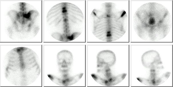 Obr. . 1  scintigrafie skeletu v zadn a pedn projekci