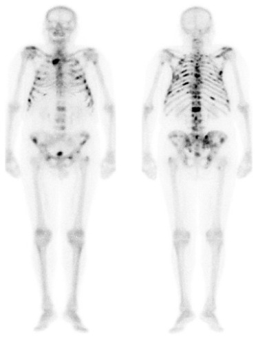 Obr. . 2  celotlov scintigrafie skeletu v pedn a zadn projekci