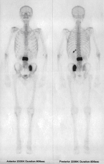 Obr. . 1  Celotlov scintigrafie skeletu v pedn a zadn projekci