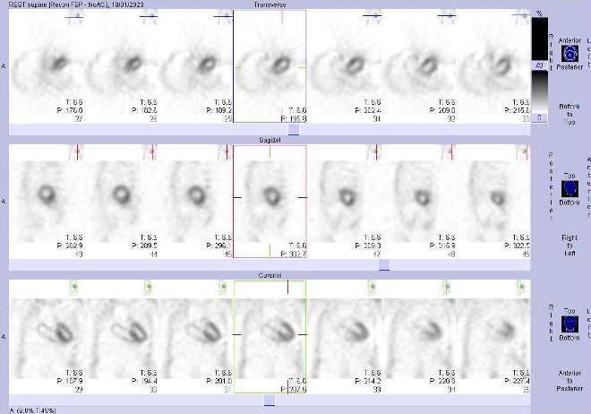 Obr..2: Celotlov scintigrafie v pedn a zadn projekci a fze obraz SPECT a CT.  Vpravo zameno na  loisko v Th ptei.