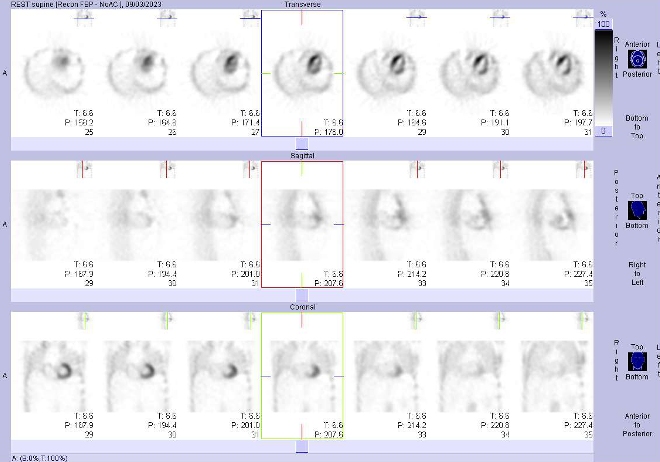 Obr..2: Gatovan tomografick scintigrafie myokardu.