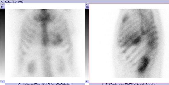 Obr.1: Statick scintigrafie hrudnku vpedn a lev bon projekci. Vyeten 3 hodiny po aplikaci radiofarmaka.