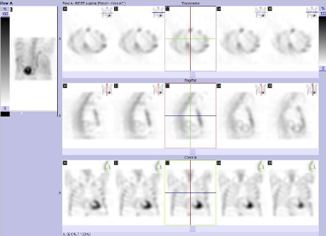 Obr. . 2: Gatovan tomografick scintigrafie myokardu.