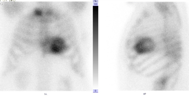 Obr. . 1: Statick scintigrafie hrudnku v pedn a lev bon projekci. Vyeten 3 hodiny po aplikaci radiofarmaka.