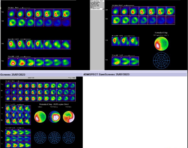 Obr. . 3: Negatovan tomografick scintigrafie myokardu.