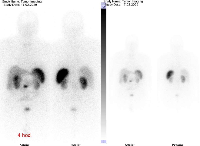 Obr. . 1: Celotlov scintigrafie v pedn a zadn projekci 4 hod. po aplikaci OctreoScanu. Dvoj modulace obrazu.
