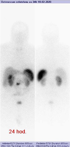 Obr. . 3: Celotlov scintigrafie v pedn a zadn projekci 24 hod. po aplikaci OctreoScanu.