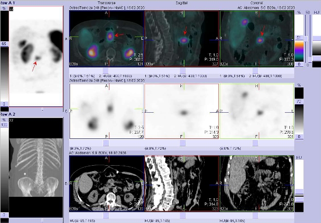 Obr. . 4: Fze SPECT/CT bicha a pnve 24 hod. po aplikaci OctreoScanu. Zameno na loisko na radixu mezenteria v blzkosti mezenterilnho cvnho svazku.