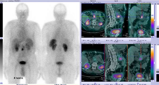 Obr. . 5: Celotlov scintigrafie a fze SPECT/CT bicha 4 hod. po aplikaci OctreoScanu. Zameno na loisko na radixu mezenteria v blzkosti mezenterilnho cvnho svazku.