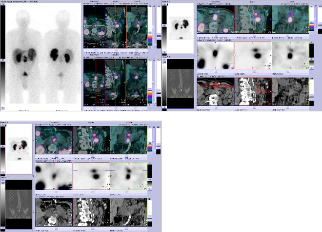 Obr. . 6-8: Fze SPECT/CT bicha 24 hod. po aplikaci OctreoScanu. Zameno na loisko v mezenteriu a loisko v retroperitoneu vpravo paraaortln, tedy na zvtenou lymfatickou uzlinu.