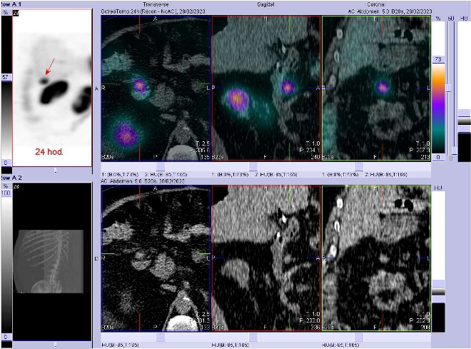 Obr. . 3: Fze SPECT/CT bicha a pnve 24 hod. po aplikaci OctreoScanu. Zameno na loisko zejm v lymfatick uzlin ventrln od duodena.