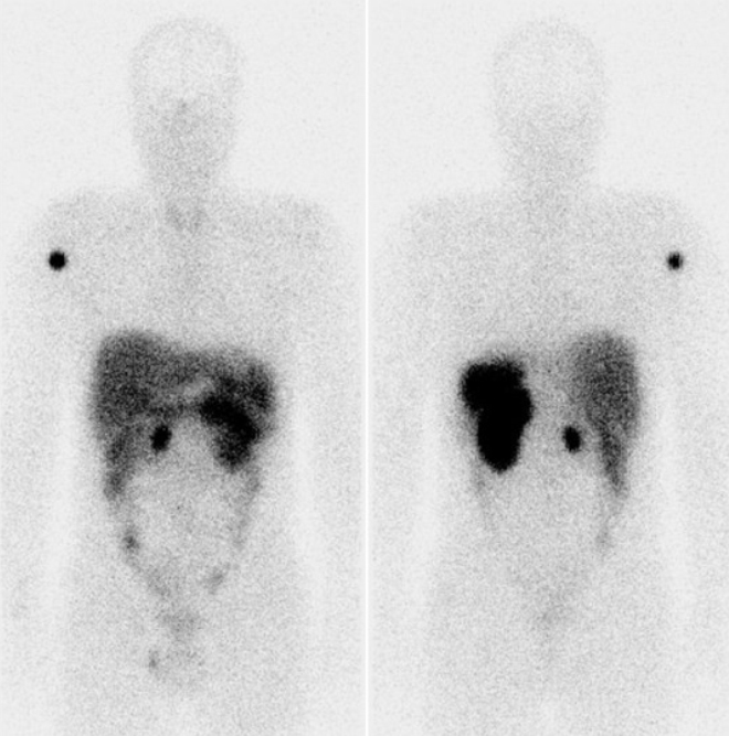 Obr. . 1: Celotlov scintigrafie v pedn a zadn projekci 24 hod. po aplikaci OctreoScanu.