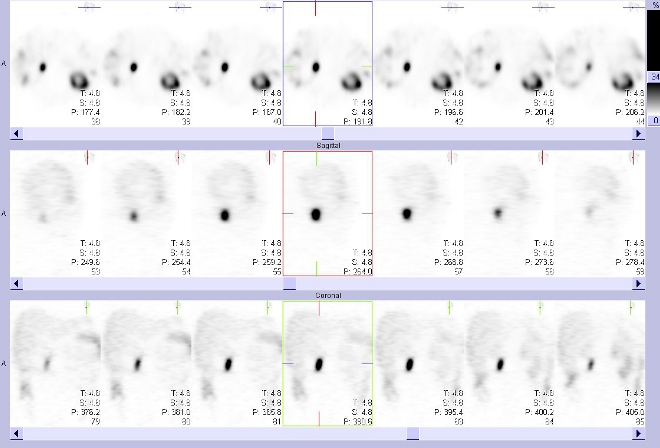 Obr. . 2: Tomografick scintigrafie bicha a pnve 24,5 hod. po aplikaci OctreoScanu. Horn ada: transverzln ezy, stedn ada: sagitln ezy, doln ada: koronln ezy.