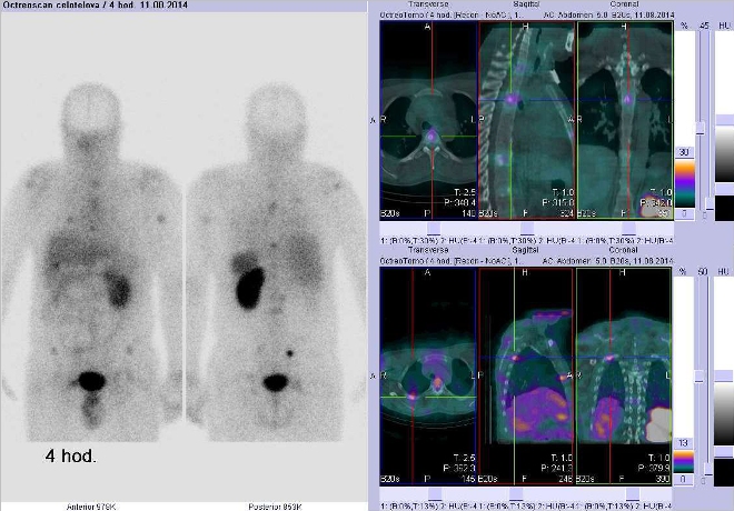 Obr. . 3: Celotlov scintigrafie v pedn a zadn projekci a fze obraz SPECT a CT. Vyeten 4 hod. po aplikaci radioindiktoru. Zameno na loisko v hrudnm obratli a dle na loisko v dorzln sti proximlnho ebra vpravo.