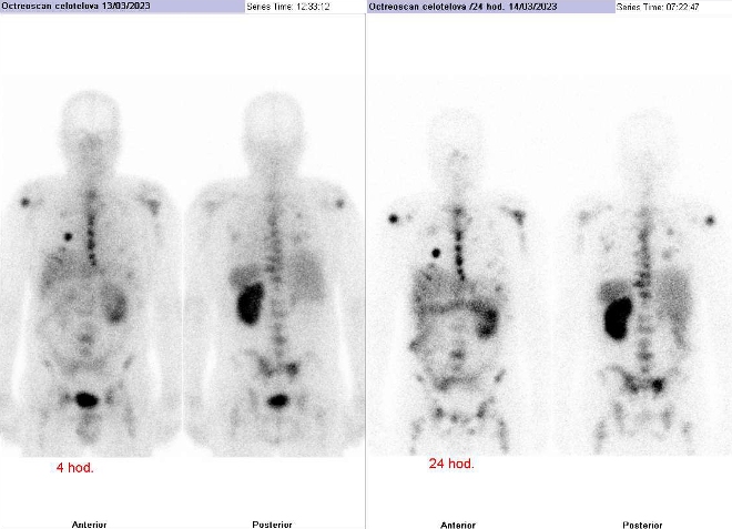 Obr. . 4: Celotlov scintigrafie vpedn a zadn projekci 4 (vlevo) a 24 hod. (vpravo) po aplikaci OctreoScanu.