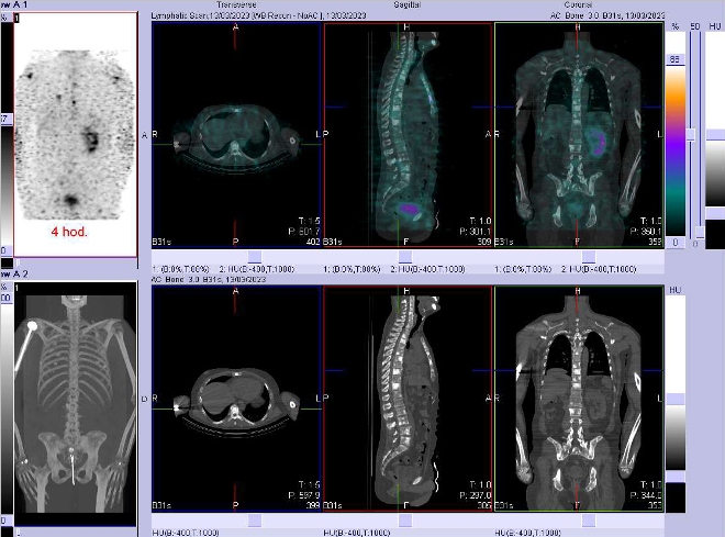 Obr. . 5: Fze SPECT/CT hrudnku, bicha a pnve 4 hod. po aplikaci OctreoScanu.