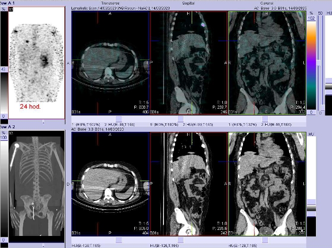 Obr. . 6: Fze SPECT/CT 24 hod. po aplikaci OctreoScanu. Zameno na jtra.