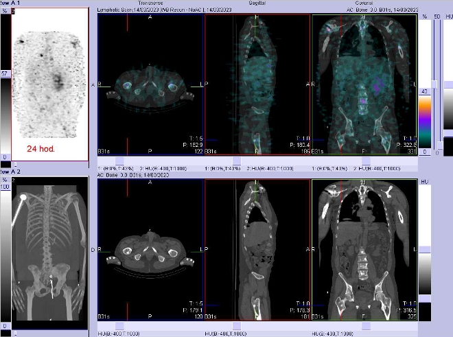 Obr. . 7: Fze SPECT/CT hrudnku, bicha a pnve 24 hod. po aplikaci OctreoScanu.