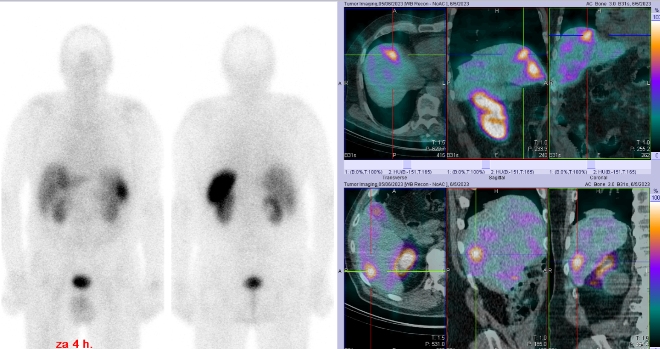 Obr. . 1: Celotlov scintigrafie a SPECT/CT bicha a pnve 4 hod. po aplikaci OctreoScanu. Zameno na loisko v pravm jaternm laloku.