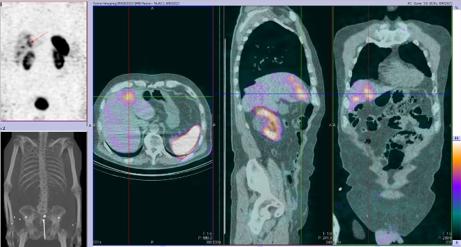 Obr. . 2: Fze SPECT/CT 4 hod. po aplikaci OctreoScanu. Zameno na loisko v pravm jaternm laloku.