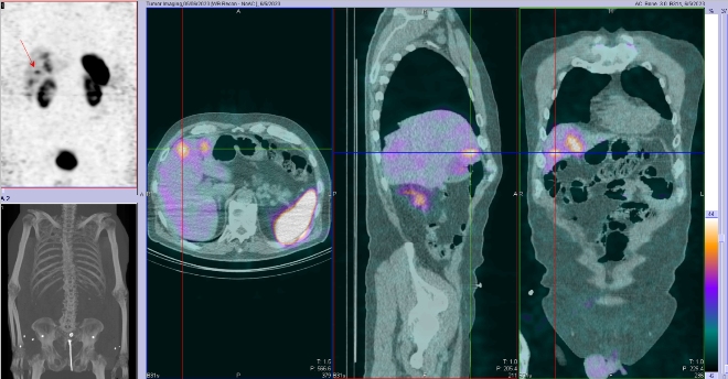 Obr. . 3: Fze SPECT/CT 4 hod. po aplikaci OctreoScanu. Zameno na loisko v pravm jaternm laloku.