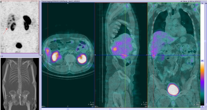 Obr. . 4: Fze SPECT/CT 4 hod. po aplikaci OctreoScanu. Zameno na loisko v pravm jaternm laloku.