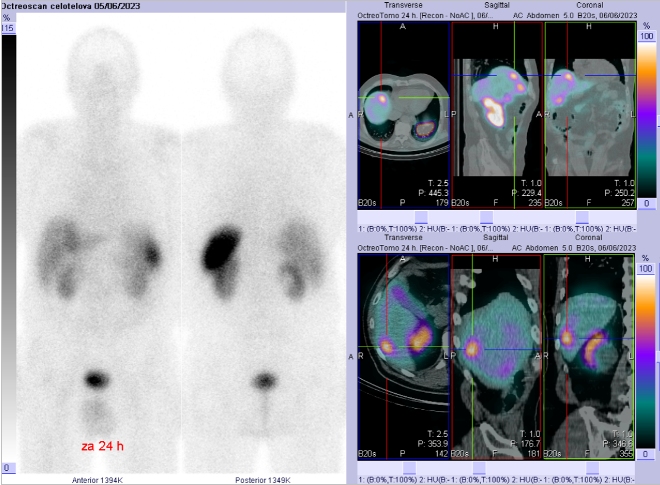 Obr. . 5: Celotlov scintigrafie a SPECT/CT bicha a pnve 24 hod. po aplikaci OctreoScanu. Zameno na loisko v pravm jaternm laloku.