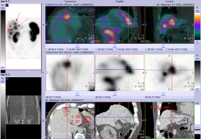 Obr. . 6: Fze SPECT/CT 24 hod. po aplikaci OctreoScanu. Zameno na loiska v pravm jaternm laloku.