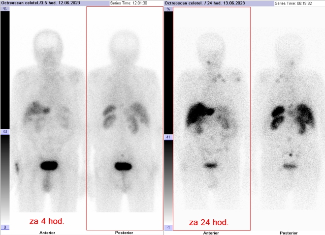 Obr. . 1: Celotlov scintigrafie v pedn a zadn projekci 4 (vlevo) a 24 hod. (vpravo) po aplikaci OctreoScanu.
